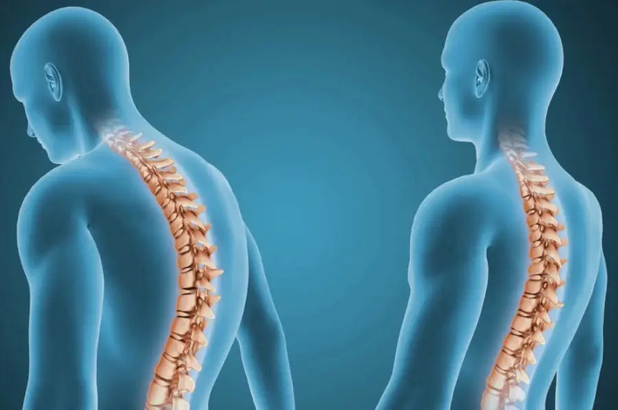 LILA ostéporose os forts